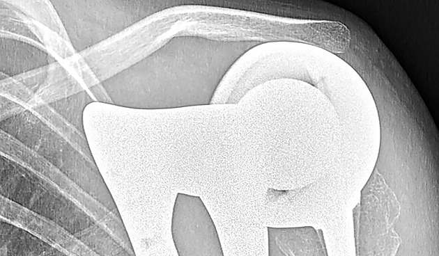Unikátní operace v Motole. Devítiletému chlapci nahradili lopatku z 3D tiskárny